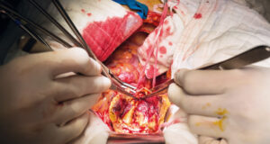 Perioperative care in open aortic vascular surgery: join upcoming webinar