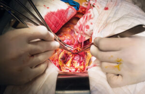 Perioperative care in open aortic vascular surgery: join upcoming webinar