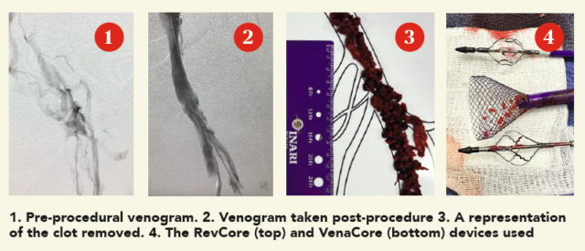 How the RevCore and VenaCore thrombectomy catheters combine to broaden ...