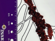 How the RevCore and VenaCore thrombectomy catheters combine to broaden treatment approach among advanced deep vein thrombosis patients previously limited to few options