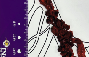 How the RevCore and VenaCore thrombectomy catheters combine to broaden treatment approach among advanced deep vein thrombosis patients previously limited to few options