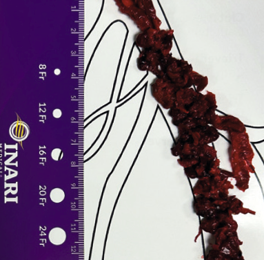 How the RevCore and VenaCore thrombectomy catheters combine to broaden treatment approach among advanced deep vein thrombosis patients previously limited to few options
