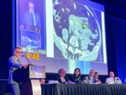 In search of the ‘holy grail’: New analysis brings aneurysm rupture prediction closer