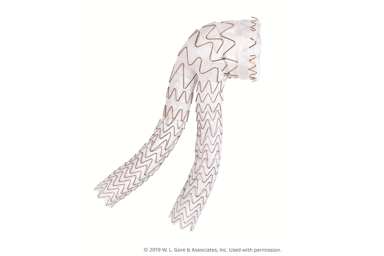 Gore announces first commercial implant of Excluder conformable AAA endoprosthesis with Active Control system in Canada