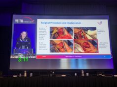 Novel bioabsorbable perivascular wrap aims to reduce AVF failure