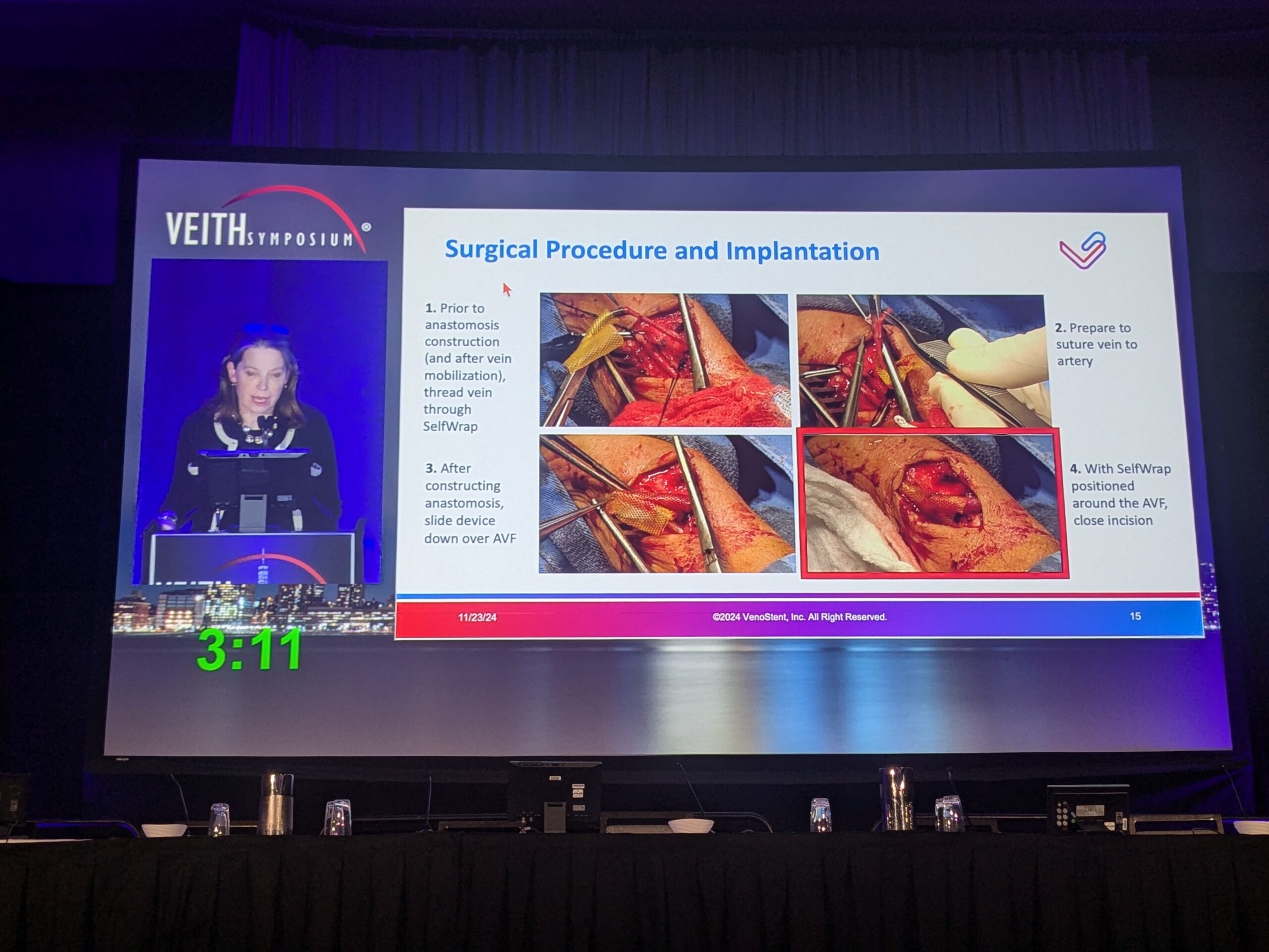 Novel bioabsorbable perivascular wrap aims to reduce AVF failure