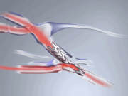 Early feasibility study for Velocity pAVF system now fully enrolled