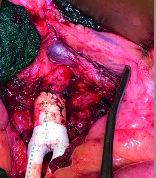 Long-term VQI-VISION analysis sheds light on PVI versus bypass in aortoiliac occlusive disease