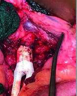 Long-term VQI-VISION analysis sheds light on PVI versus bypass in aortoiliac occlusive disease