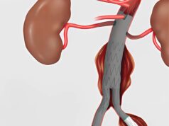 Cook announces US launch of Zenith iliac branch device