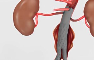 Cook announces US launch of Zenith iliac branch device