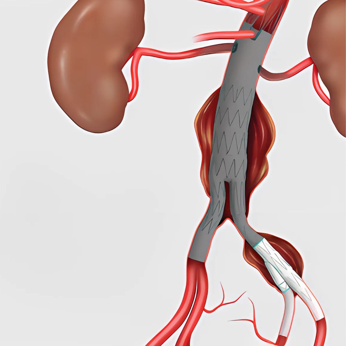 Cook announces US launch of Zenith iliac branch device