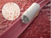 StentIt launches first-in-human trial of bioresorbable stent to treat below-the-knee CLTI