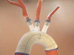 Aquedeon Medical receives FDA approval to expand clinical trial of Duett vascular graft system