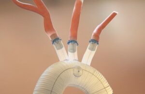 Aquedeon Medical receives FDA approval to expand clinical trial of Duett vascular graft system