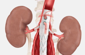 Final patient treated in Cook’s Zenith Fenestrated+ endovascular graft clinical study