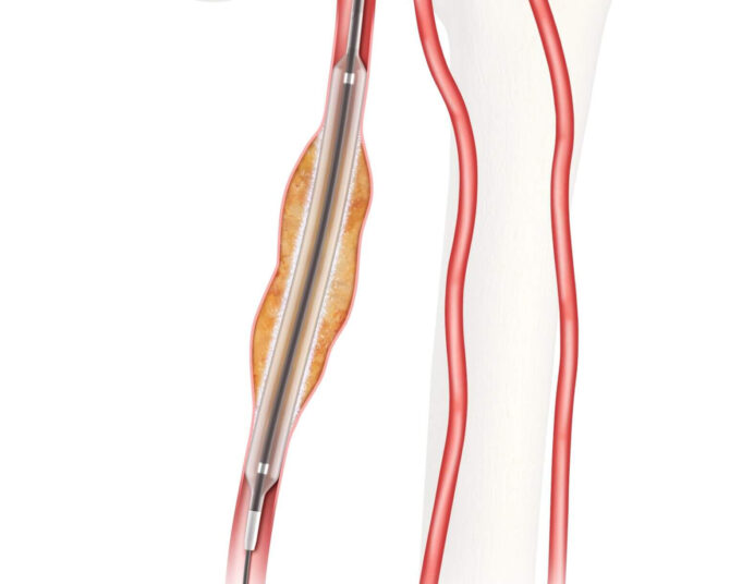 FDA grants approval for IDE study on Advance Evero 18 everolimus-coated balloon catheter