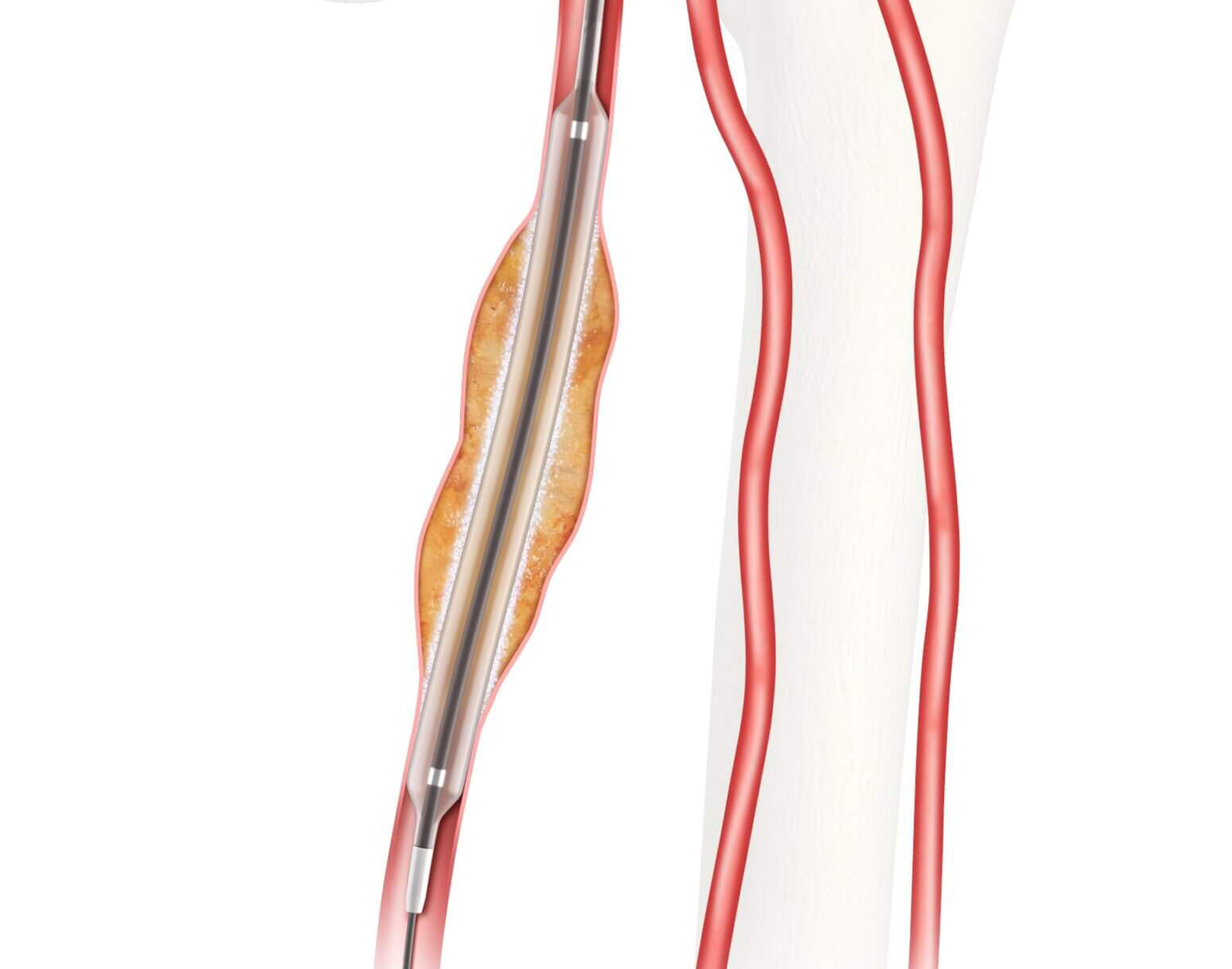 FDA grants approval for IDE study on Advance Evero 18 everolimus-coated balloon catheter