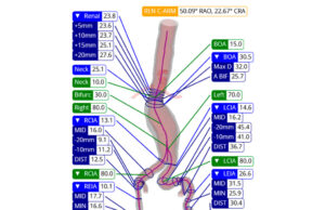 ViTAA Medical announces FDA 510(k) clearance for aortic planning platform
