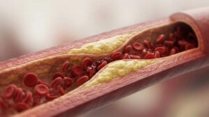 ROADSTER 3 analysis explores role of TCAR in asymptomatic carotid disease