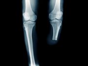 x-ray image below knee amputation or BKA amputation