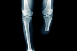 x-ray image below knee amputation or BKA amputation