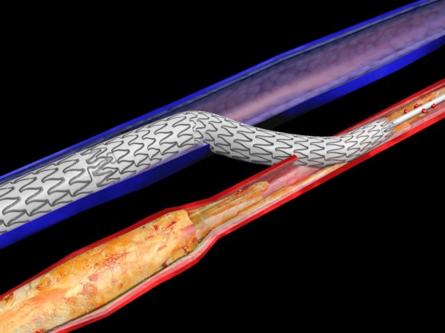 PROMISE II U.S. pivotal trial of device designed for ‘no-option’ CLTI patients completes enrollment