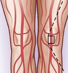 Ra Medical Systems receives FDA approval for increased enrollment in atherectomy clinical trial