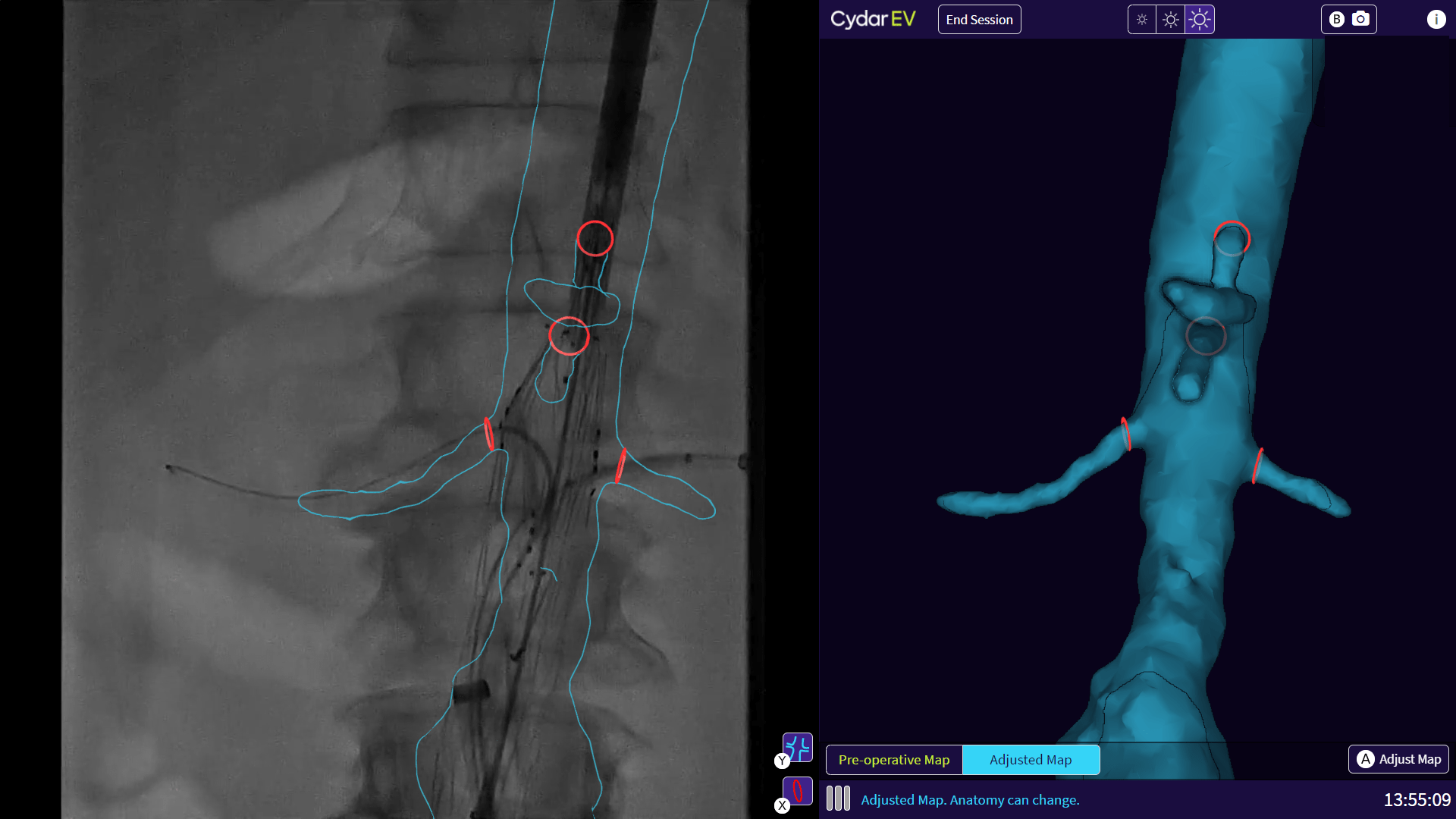 First patient treated in global strategic collaboration involving Cydar Maps technology