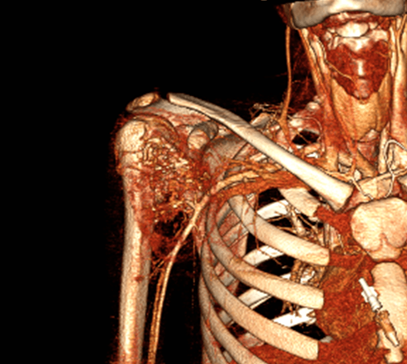 Rare case series shows 100% limb salvage in pediatric bone tumor resections with vascular involvement