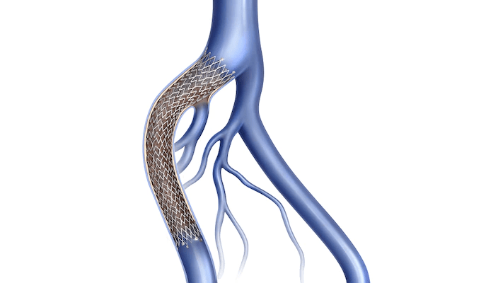 Venovo venous stent returns to US market after 2021 recall