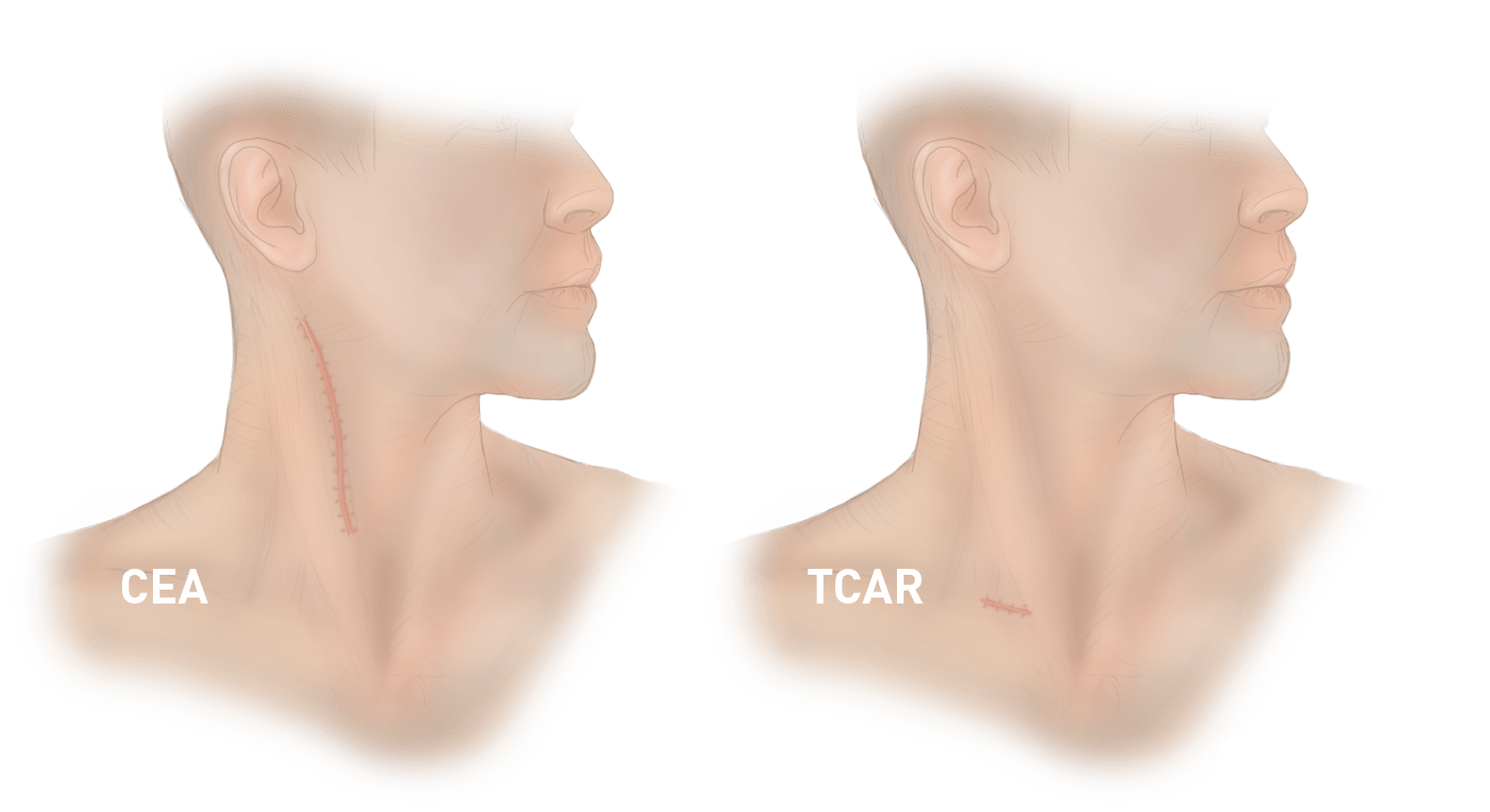 Silk Road to evaluate TCAR in standard surgical risk patients with ROADSTER 3 study