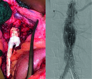 Aortobifemoral grafting in the endovascular era: An exploration of the open procedure and its merits among ‘good-risk’ patients today