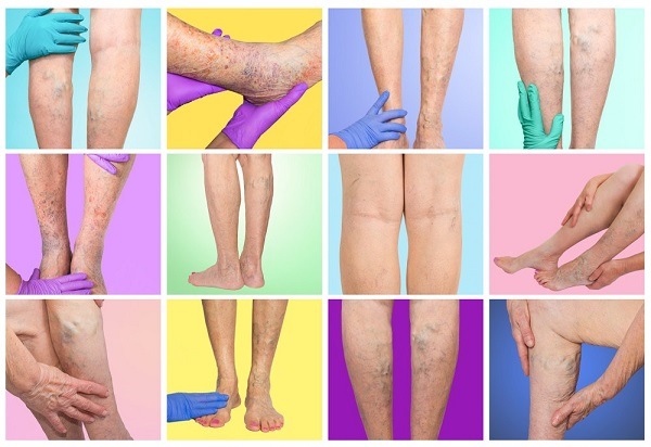 Symptoms of Venous Insufficiency - Delaware Vein Center