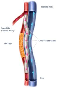 Endologix announces first patients treated with the Detour system