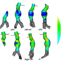 New study reports positive performance of AI-powered assessment of biomarkers for growth prediction of AAAs