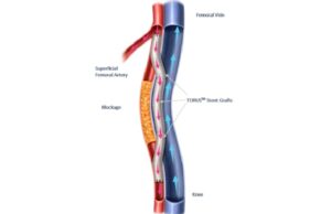 FDA gives nod to first fully-removable percutaneous peripheral