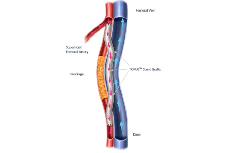 Endologix initiates postmarket study of the Detour system