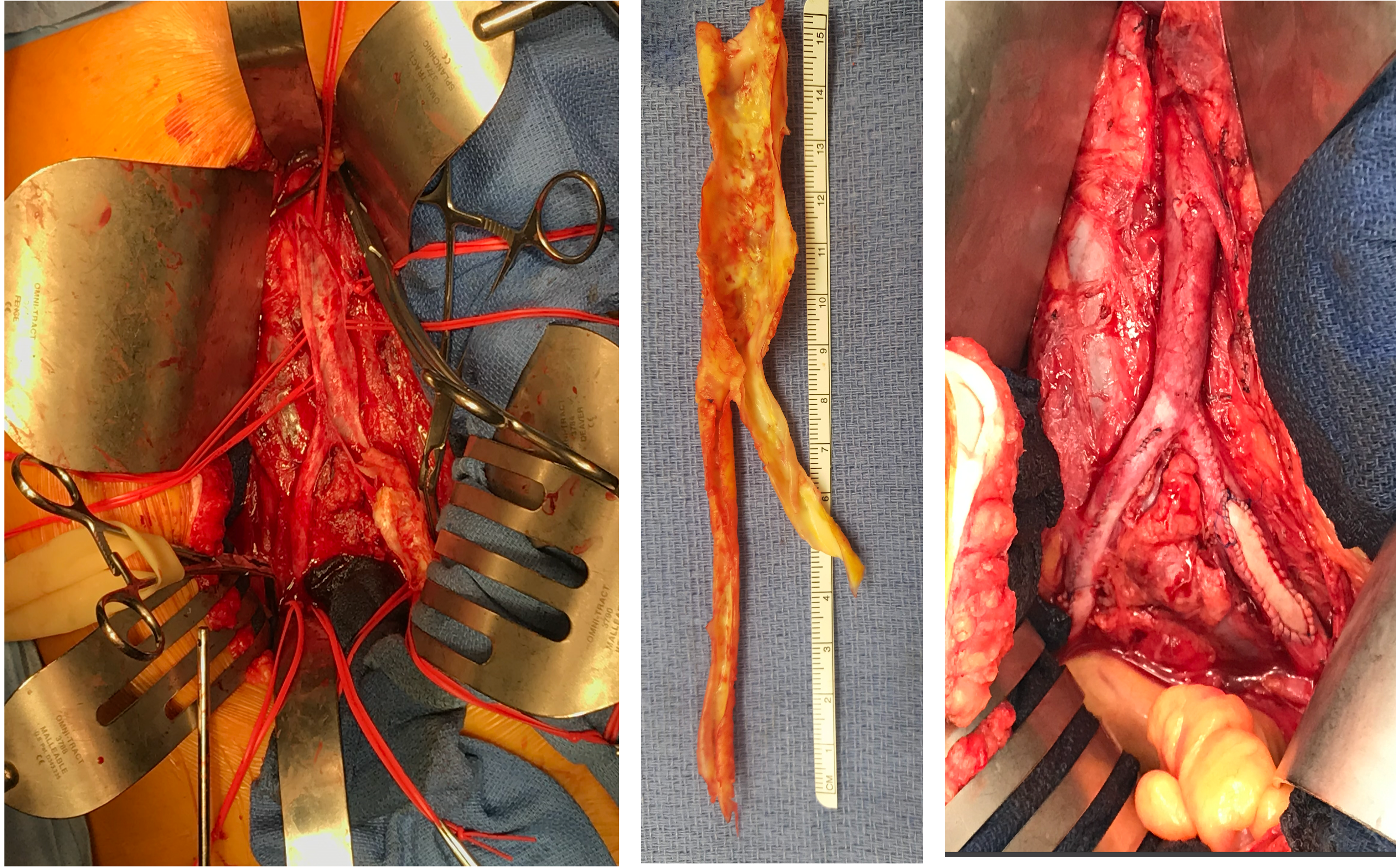 Re-evaluating aortoiliac endarterectomy: Case series shows ‘acceptable durability’