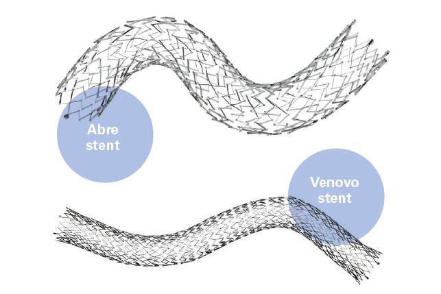 Nitinol stents placed in iliac veins “not associated with prolonged back pain,” study finds
