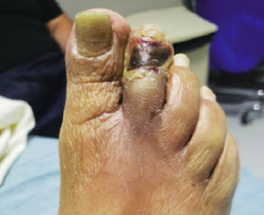 Incorporation of Shockwave E8 Peripheral IVL into the treatment of patients with chronic limb-threatening ischemia