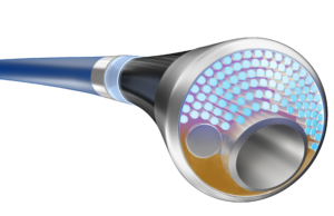 First patient enrolled in study of integrated laser atherectomy and IVL catheter