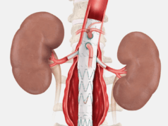 Final patient treated in Cook’s Zenith Fenestrated+ endovascular graft clinical study