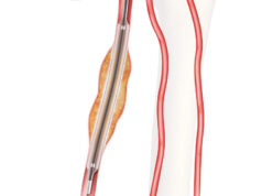 FDA grants approval for IDE study on Advance Evero 18 everolimus-coated balloon catheter